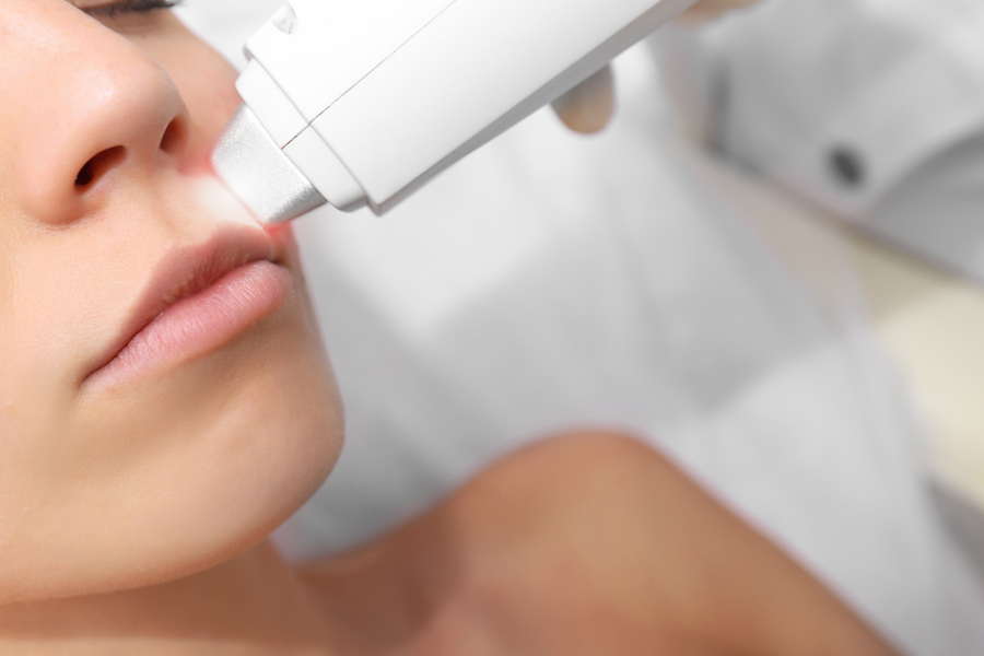 laser hair removal laser